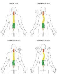 ريا المسكرية בטוויטר 3 idiopathic scoliosis اكثر حالات الجنف شيوعا حيث يطرأ الانحراف في فترة النمو توجد عوامل تغير من درجة الانحراف الا ان الأسباب التي ادت الى ذلك غير معروفة