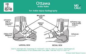 Ottawa Ankle Rule Mdcalc Athletic Training Sports Medicine Physical Therapy Education Physical Therapy Student