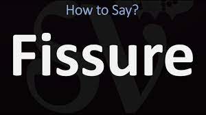 How to say posterior median fissure in portuguese? How To Pronounce Fissure Correctly Youtube