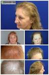 Haartransplantation Haarverpflanzung Adressen Hautärzte Kiel
