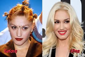 Being the lead singer of . Gwen Stefani Before And After Surgery Plastic Surgery Mistakes