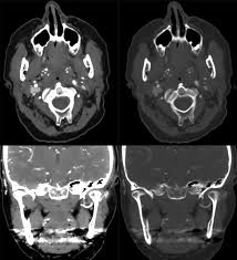 Image result for Tonsillolith