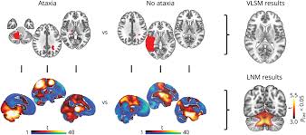 Image result for Neurologic Lesion Localization