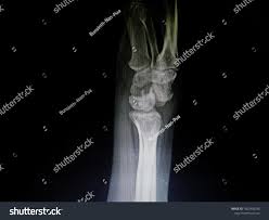 Image result for Scapholunate Dislocation