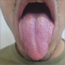 Image result for black hairy tongue symptoms