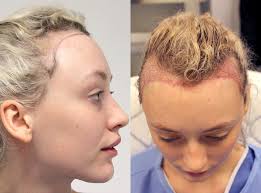 This may include the use of different hairstyles for receding hairline in women and many others. This Woman Started Balding Because Of Her Too Tight Buns Self