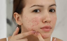 Nguyên Nhân Da Bị Mụn, Cách Chăm Sóc Hiệu Quả | Kiehl's