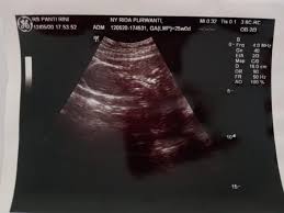 Seperti yang kita ketahui, buah durian sangat dilarang bagi ibuhamil. Pengalaman Bo Dan Iufd Part4 Halaman All Kompasiana Com