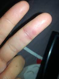 Adern Im Mittelfinger Dick Was Kann Das Sein Finger Blutgefass