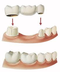 They involve the installation of a pontic (false tooth or teeth) that is connect either via abutments placed on healthy teeth, or metal wings that are bonded to the back of healthy teeth. Crown And Bridge Empress Dental Care Clinic