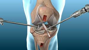 The aixc access control list (acl) type represents the behavior of the acl type supported on aix releases prior to 5.3.0. Acl Tear Surgery Reconstruction Orthosports Medical Center