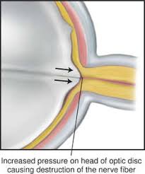 The only way to find out if you have glaucoma is to get a comprehensive dilated eye exam. Glaucoma Definition Of Glaucoma By Medical Dictionary