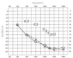 Audiograms Aussie Deaf Kids