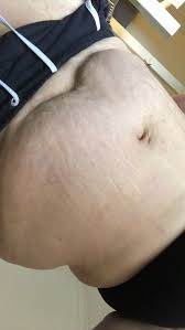 Will Loose Skin Go Away Mumsnet