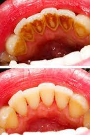 Bleeding Gums What Does It Mean Docklands Dental Blog