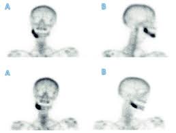 Image result for Osteomyelitis Bone Scan