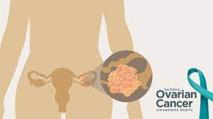 Ct is considered the best imaging modality for staging ovarian cancer. National Ovarian Cancer Awareness Month Right At Home In Home Care For Seniors