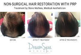 Microneedling Prp Hair Restoration At Dream Spa Medical Help Hair Loss Hair Restoration Hair Loss Remedies