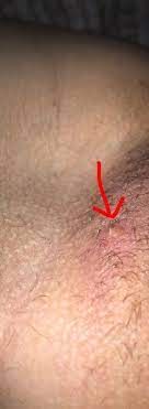 The groin area is particularly prone to ingrown hair with the result being sores and painful bumps. I Stuck A Needle Into This White Cyst Like Growth On My Labia Majora Then I Very Aggressively Squeezed Out A Mixture Of Pus And Blood Sorta Regretting My Decision Any Tips On
