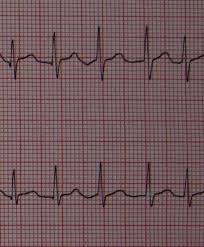Atrial Fibrillation Wikipedia