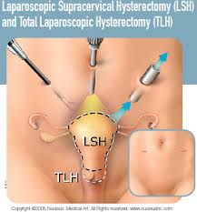 Medical illustration of laparoscopic supracervical and total hysterectomy approaches