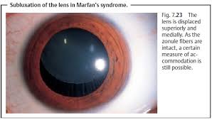 Image result for Lens Dislocation