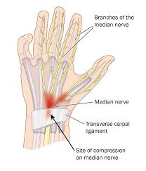 Carpal Tunnel Syndrome Guide Causes Symptoms And Treatment Options