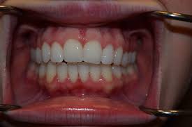 Best to see your dentist, and bring in the prior two trays for evaluation. Does Invisalign Work Austin Tx Smile360