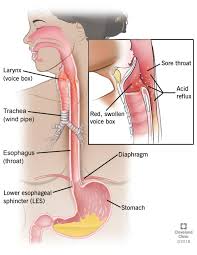 How to deal with too. Laryngopharyngeal Reflux Lpr Symptoms Diagnosis Treatment
