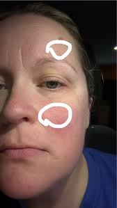 How to Get Rid of Milia: Those Annoying Fat Cysts