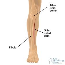 Image result for Shin Splints