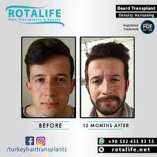 Pin By Sadegh Taheri On Hair Replacement In 2021 Beard Transplant Hair Replacement Hair Transplant