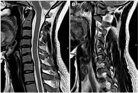 In fact, the facet joints receive their nerve supply from the medial branch of the dorsal rami (bogduk 1997). Posterior Unlocking Of Facet Joints Under Endoscopy Followed By Anterior Decompression Reduction And Fixation Of Old Subaxial Cervical Facet Dislocations A Technical Note Sciencedirect