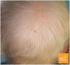 Skin cancer usually develops in areas of the body that are exposed to sunlight, such as the. Skin Cancer On Scalp Skin Check Waskin Check Wa