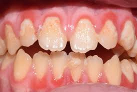 Image result for Gingivitis