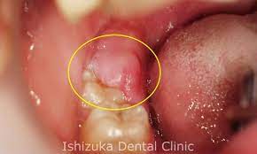 歯の生え変わりで起こりやすい萌出性歯肉炎 | 石塚歯科医院