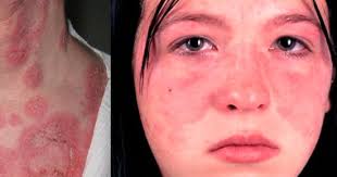 ما هي نسبة فحص ana والمعروف باسم antinuclear antibodies وهو فحص يبين كمية الأجسام المضادة التي تنتج من خلال جهاز المناعة ضد النواة، أو هو ما يعرف اختصارًا بتحليل (ana)، ولا يتطلب إجراء الفحص عادةً فعل شيء قبل إجراء التحليل. Ø§Ù„Ø°Ø¦Ø¨Ø© Ø§Ù„Ø­Ù…Ø±Ø§Ø¡ Ù…Ø±Ø¶ Ù…Ù†Ø§Ø¹Ù‰ ÙŠÙ‡Ø§Ø¬Ù… Ø£Ø¹Ø¶Ø§Ø¡ Ø§Ù„Ø¬Ø³Ù… Ø¨Ø´Ø±Ø§Ø³Ø© ÙˆÙŠÙƒØ³Ø± Ø§Ù„ØµÙØ§Ø¦Ø­ Ø§Ù„Ø¯Ù…ÙˆÙŠØ© Ø§Ù„ÙŠÙˆÙ… Ø§Ù„Ø³Ø§Ø¨Ø¹