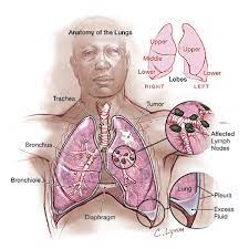 Still other symptoms involve metabolic. Lung Cancer India Lung Cancer Treatment Cost India India Lung Cancer