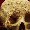 Pain is the most common sign of bone cancer, and may become more noticeable as the tumor grows. Https Encrypted Tbn0 Gstatic Com Images Q Tbn And9gcqzezn1vkykgrq5r E1tqdw1dir7k2ce5dfvaillnzzpocobs9i Usqp Cau