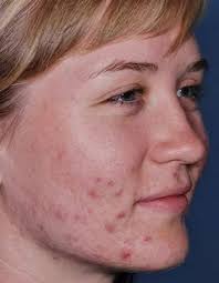 REAL RESULTS! Clenziderm MD by...