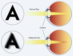 Maybe you would like to learn more about one of these? Lazy Eye Amblyopia Treatment Eye Specialist Nyc Ophthalmologist