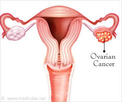 Here are the procedures on how is ovarian cancer diagnosed. Ovarian Cancer Can Be Detected Using This Test