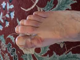 Pain, swelling, and bruising are common. Anyone Ridden W A Broken Big Toe Training Trainerroad