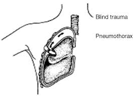 Pleura Space Anatomy Abstract Europe Pmc