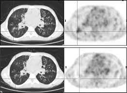 Cystic fibrosis is an inherited condition in which the lungs and digestive system can become clogged with thick, sticky mucus. 18f Fluorodeoxyglucose Pet Ct Imaging Of Lungs In Patients With Cystic Fibrosis Sciencedirect