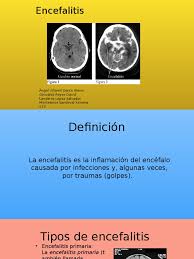 Early symptoms are fever, sensitivity to light, and headache. Encefalitis Virus Sistema Nervioso Central