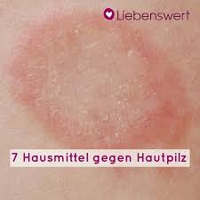 Liebenswert 7 Hausmittel Gegen Hautpilz Facebook