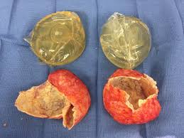 The implant may go flat right away, in the case of a rupture, or take several days or weeks to deflate if there is a small leak. Five Reasons Why You Need To Monitor Your Breast Implants Pacific Plastic Surgery Plastic Surgery Centers
