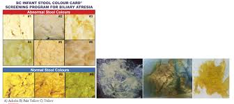 Image result for acholic stools human