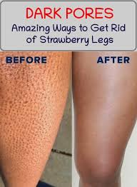 How To Finally Get Rid Of Strawberry Legs In 2020 Strawberry Legs Ingrown Leg Hair Shaving Legs Tips
